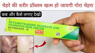 Betnovate N Cream  Betnovate n lagane sekya hota hai  फायदे और नुकसान  Review [upl. by Annaujat]