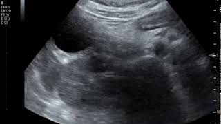 Acute Cholecystitis Ultrasound JETem 2018 [upl. by Sheffie460]