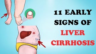 11 Early Signs of Liver Cirrhosis  Healthy Care [upl. by Niarbo]