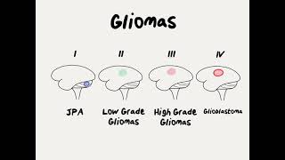 Doctor Explains Glioma Brain Tumor [upl. by Ifen]