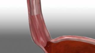 Barrx™ 360 RFA Balloon Catheter Animation [upl. by Assenyl155]