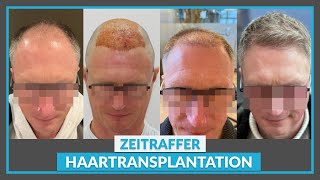 Zeitraffer nach Haartransplantation 1 – 3 – 6 – 9 – 12 Monate Wachstumsverlauf [upl. by Abigail829]