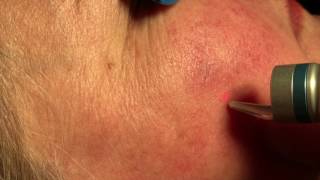 Dr Laura uses a vascular laser to erase facial spider veins like magic [upl. by Ydroj66]