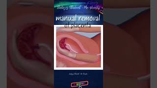 Manual removal of placenta shortsfeed shorts trending viralvideo ytshorts biology science 3d [upl. by Siegfried939]