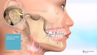 Carriere® Motion™ Appliance for Class II Patient Education Animation [upl. by Aldridge]