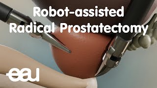 Robotassisted Radical Prostatectomy RARP [upl. by Doxia]