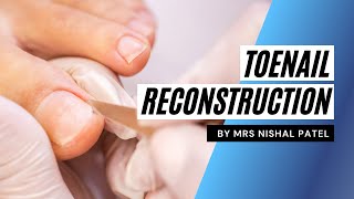 Toenail Reconstruction By Mrs Nishal Patel [upl. by Olfe]