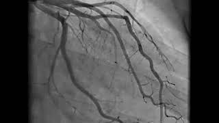 Coronary Angiography  NEJM [upl. by Mccartan]