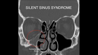 Silent Sinus Syndrome [upl. by Madison]