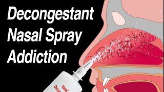 Decongestant Nasal Spray Addiction Afrin Zicam Sinex NeoSynephrine etc [upl. by Itoyj977]