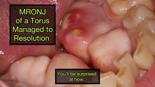 MRONJ of Mandibular Torus Treated to Resolution [upl. by Aitetel]