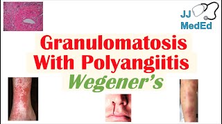 Granulomatosis with Polyangiitis Wegener’s granulomatosis  Symptoms Diagnosis Treatment [upl. by Catton52]