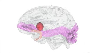 3Dimensional Reconstruction of Dominant Hemisphere Gliomas [upl. by Htennaj]