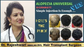 Female Alopecia Cured By DrRajeshwari [upl. by Georgianne]