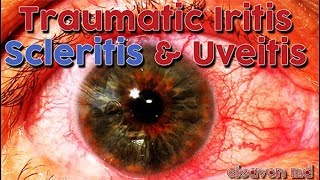 Cleavon MD  Traumatic Iritis Scleritis and Uveitis [upl. by Nanaek]