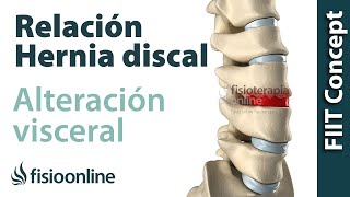 ¿Cómo se produce una hernia discal por una disfunción o alteración visceral [upl. by Goldner]