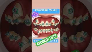 CROOKED TEETH BRACES 😬 [upl. by Chaker736]