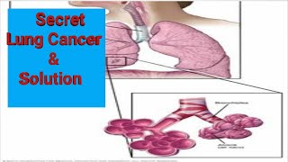 Lung Cancer Secrets amp SolutionsWhat You Need to Know [upl. by Ilsel317]