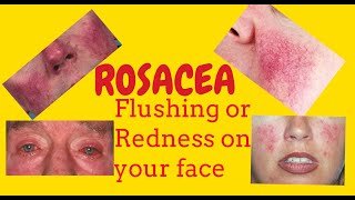 Rosacea or Potato nose or Rhinophyma or Redness of the face Phymatous rosacea Telangiectasia [upl. by Esiuol]