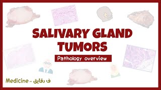 Salivary glands tumors  Pleomorphic adenoma Warthin tumor pathology overview شرح [upl. by Uriel]