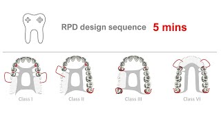 RPD design in 5 mins [upl. by Linette598]