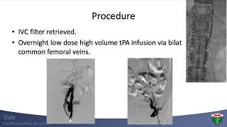 CVI 2020 Vein Case  One of my most memorable vein cases Why venous return matters [upl. by Aniras620]