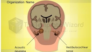 Acoustic Neuroma Vestibulocochlear Nerve Medical PPT Presentation Template by TheTemplateWizardcom [upl. by Good]