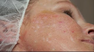 Camouflaging scars with micropigmentation [upl. by Ynitsed]