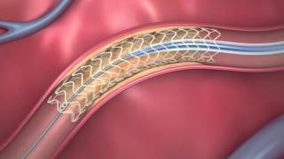 FDAApproved Dissolving Heart Stent  How It Works [upl. by Oinafipe]