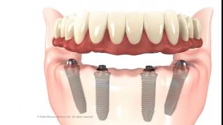 All on four solución con implantes dentales para recuperar tu sonrisa en un día [upl. by Golliner]