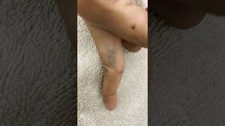 Tattoo remove creamtattoo remove laser skincare qswitchlaser [upl. by Martino]