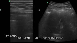 Linear Vs Curvilinear Lung Consolidation with Air Bronchograms in Adolescent with Pneumonia [upl. by Alliuqat]