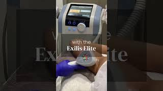 Sagging Arms Begone with Exilis Elite [upl. by Callery841]