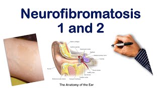 Neurofibromatosis NF 1 2 Mnemonic  USMLE STEP COMLEX NCLEX [upl. by Ynohtn]