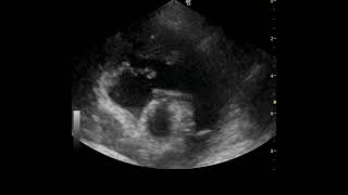 Right ventricular thrombus in a hypoalbuminaemic dog [upl. by Eiramanig]