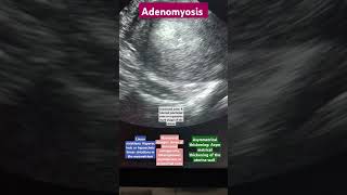 ultrasonography usg3d usg uterusanatomy uterus adenomyosis femaleanatomy love music [upl. by Streetman770]