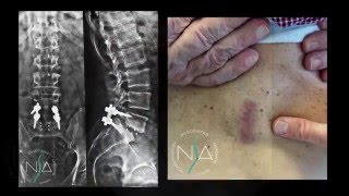 Spondilolistesi L5S1 artrodesi miniinvasiva tecnica MAS Plif  NSA Neurochirurgia [upl. by Paddie]