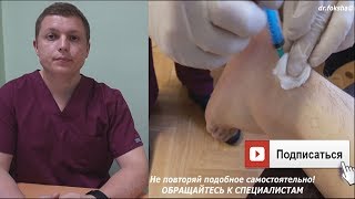 Техника блокады лодыжки  Блокада икроножного нерва по Брауну  Sural Nerve Block [upl. by Bronwen]