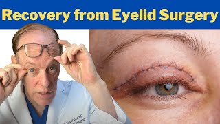 How to Recover from a Blepharoplasty  Plastic Surgeons Guidance on Eyelid Surgery Recovery [upl. by Timus]