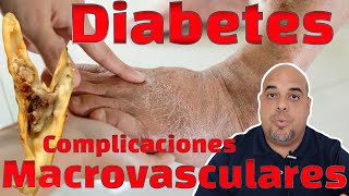 Diabetes Mellitus y Complicaciones Macrovasculares [upl. by Gosnell]