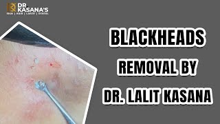 Blackhead removal Dr Lalit kasana  blackhead removal on face This week 2022 [upl. by Gwyn155]