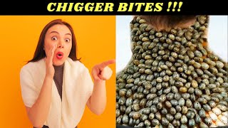 Chigger Bites Should You Worry And How Should You Treat Them [upl. by Jason435]