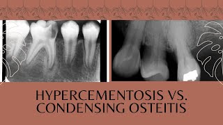 Hypercementosis vs Condensing Osteitis [upl. by Call]