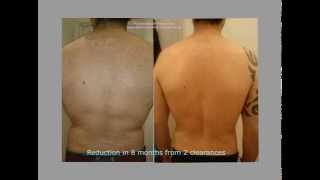 Male back clearance by electrolysis [upl. by Yelak626]