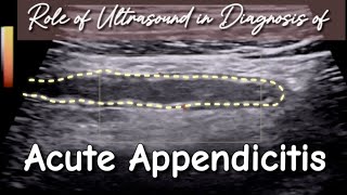 Ultrasound Acute Appendicitis  How to Prevent from False ve Diagnosis in Initial Stage [upl. by Sussman548]