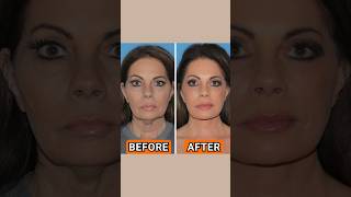 Deep Plane Facelift Testimony cosmeticsurgery antiaging beauty testimony [upl. by Pen]