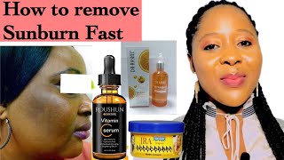 How To Remove Sunburn From Face Fast  sunburn cream [upl. by Kale855]