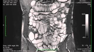 Cine MR imaging of the small intestine in a case of bowel MRI [upl. by Vida]