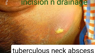 tuberculous neck abscess  incision n drainage  dr youtube doctor [upl. by Breskin783]