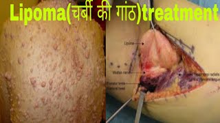 LipomaFat lumpचर्बी की गांठ treatment Hakeem sahab online [upl. by Nylissej]